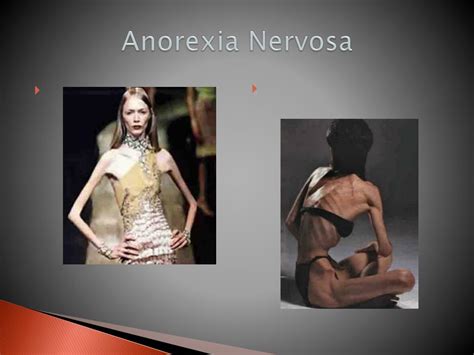 anorexia nervosa wikipedia.